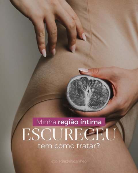 Mulher de perfil segurando fruto escurecido representando sua região intima que escureceu